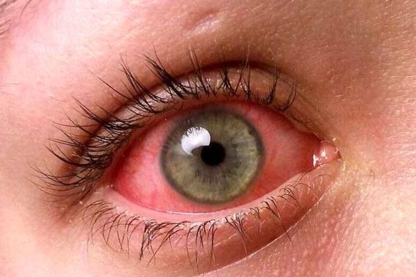 چشم صورتی نشانه عجیب ابتلا به اومیکرون!