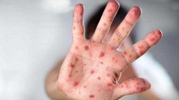 از آبله میمون چه خبر؟ از آبله میمون چه خبر؟